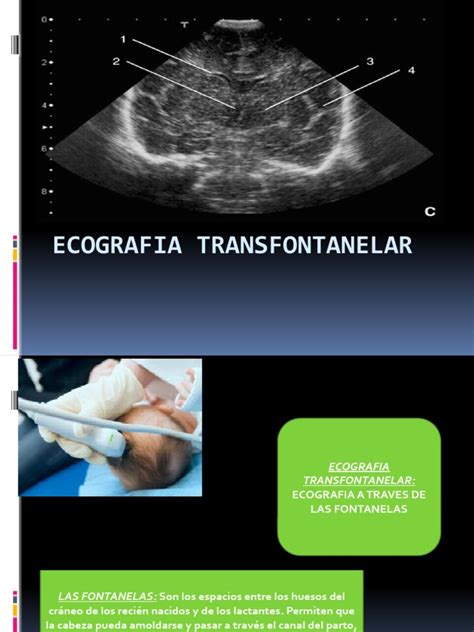 ecografia transfontanelara|Transfontanelar Ultrasound Technique, Normal Anatomy